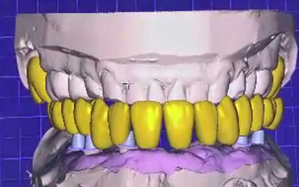 Сканирование зубов цифровой технологией 3shape TRIOS