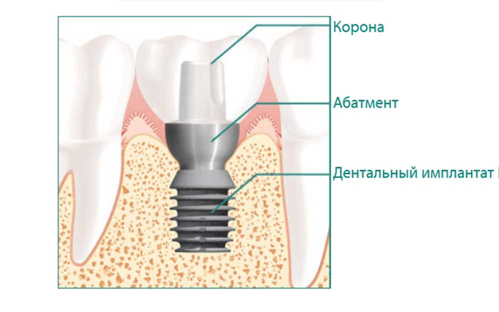 Установка имплантов с коронкой
